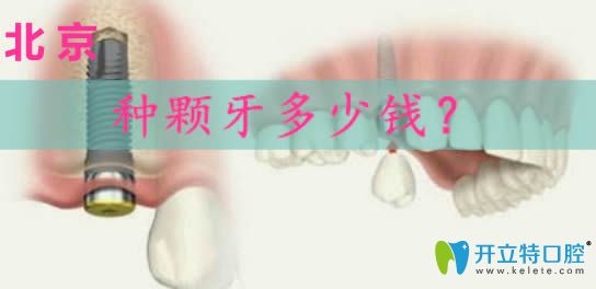 北京做種植牙的價格是多少錢一顆