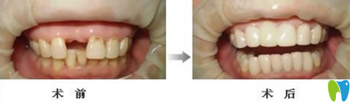 英博口腔門牙缺失種植牙案例對比圖