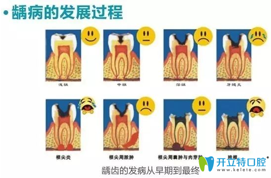 醫(yī)生科普：兒童乳牙齲齒怎么治療及要不要補牙