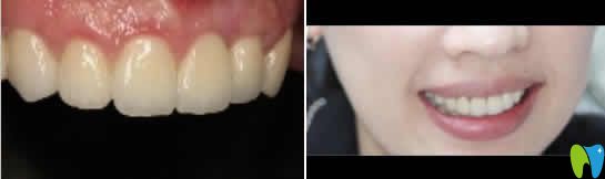 我在烏魯木齊凱樂口腔做即刻種植牙后效果