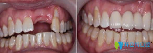 人工種植牙前后效果對(duì)比圖