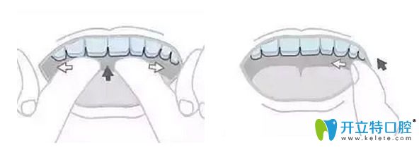 隱適美隱形牙套佩戴方法