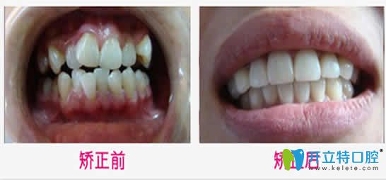 武漢優(yōu)益佳口腔牙齒矯正案例效果圖