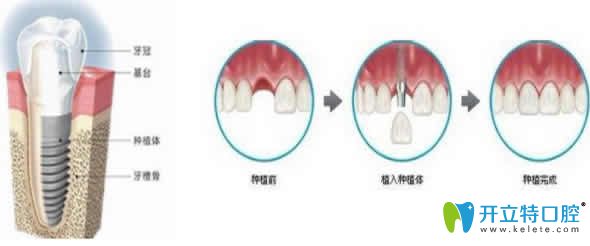 人工種植牙價(jià)格