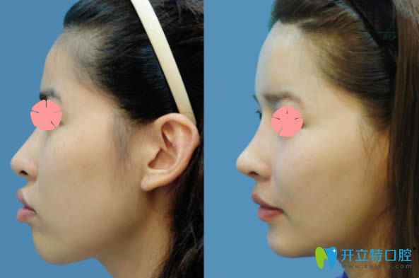 成都市西區(qū)口腔科中度雙頜前突矯正側(cè)臉前后對比照
