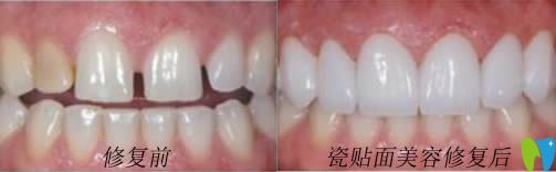 開立特網(wǎng)站牙齒貼面美容修復前后對比照