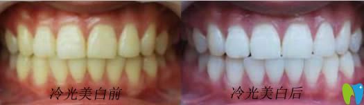 開立特牙齒美容修復前后對比圖