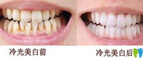 氟斑牙冷光美白前后效果圖