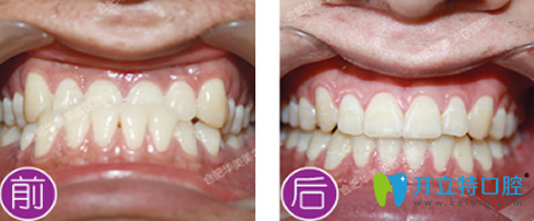 楊松牙齒地包天矯正案例 楊松牙齒地包天矯正案例