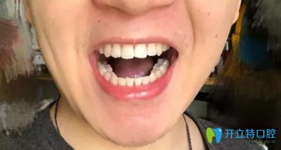 閆路做牙齒矯正摘掉牙套之后照片 閆路做牙齒矯正摘掉牙套之后照片