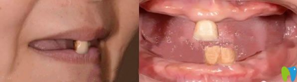 寧波美萊口腔牙齒缺失種植牙前 寧波美萊口腔牙齒缺失種植牙前