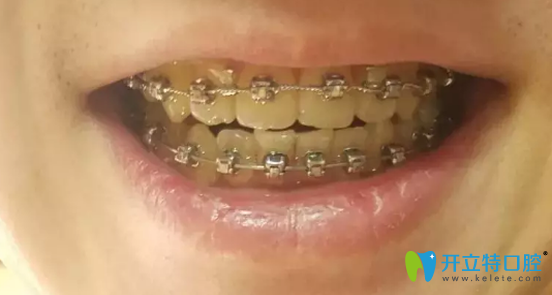 華美口腔摘牙套前較后一次復(fù)診 華美口腔摘牙套前較后一次復(fù)診