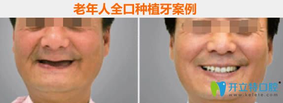 哈爾濱拜博60歲老人全口種植牙案例及1年后的感受 哈爾濱拜博60歲老人全口種植牙案例及1年后的感受