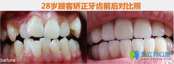 哈爾濱拜博口腔28歲隱適美矯正牙齒前后對比后效果照 哈爾濱拜博口腔28歲隱適美矯正牙齒前后對比后效果照