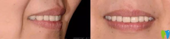 美萊口腔牙齒缺失種植牙恢復(fù)效果圖 美萊口腔牙齒缺失種植牙恢復(fù)效果圖