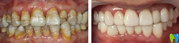 美萊口腔邱美芳院長(zhǎng)四環(huán)素牙代表案例