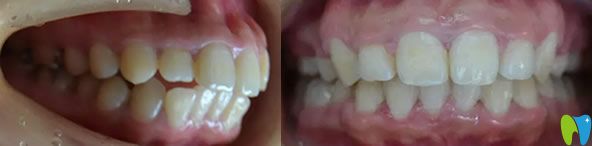 龍學(xué)輝主任齙牙矯正代表案例效果對(duì)比圖