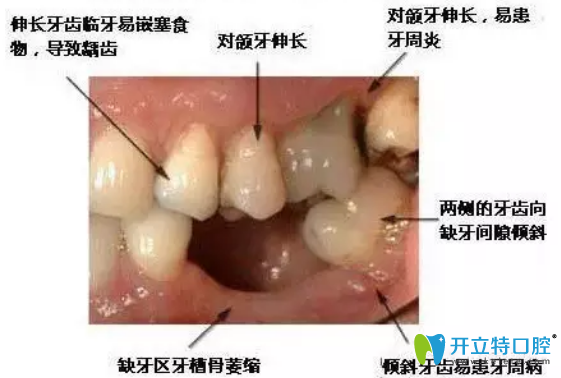 拔牙后鑲牙有沒有時間？