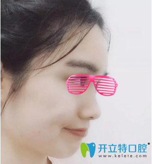 矯正牙齒12個月&lt;span style=