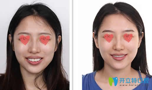 我在長沙雅美口腔做隱形牙齒矯正前后效果對比圖