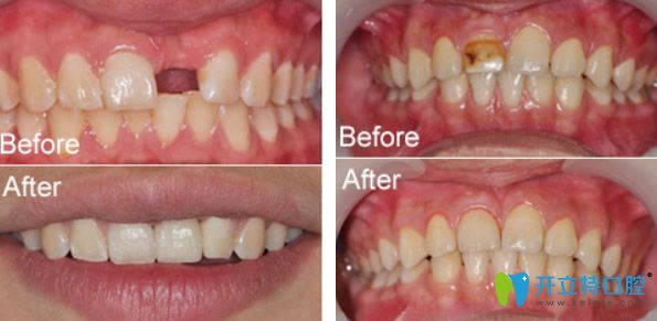 維樂口腔種植牙及色素牙修復(fù)效果對(duì)比圖 維樂口腔種植牙及色素牙修復(fù)效果對(duì)比圖