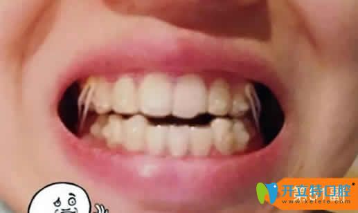 我找長沙雅美口腔劉景做隱形牙齒矯正第51副牙套照片