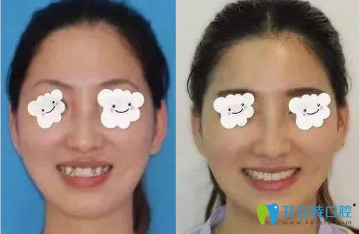 長沙雅美口腔程星醫(yī)生隱形牙齒矯正案例效果對比圖 長沙雅美口腔程星醫(yī)生隱形牙齒矯正案例效果對比圖