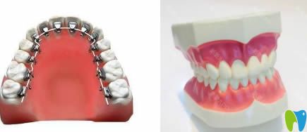 王曉琳院長科普隱適美和舌側矯正哪個好 王曉琳院長科普隱適美和舌側矯正哪個好