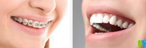 請問牙齒矯正年齡有限制嗎？解惑牙齒矯正幾歲合適