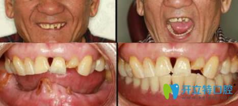 北京齒泰華口腔半口牙種植效果對(duì)比圖