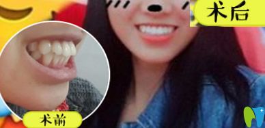 王云隱形牙齒矯正案例前后效果對比圖