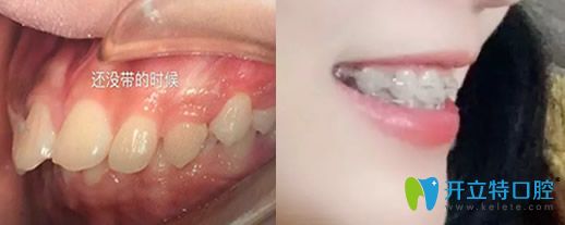 26歲牙齒正畸前后對比圖 26歲牙齒正畸前后對比圖