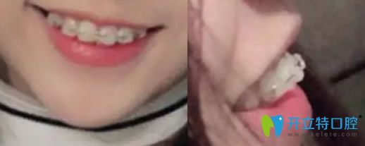 沈陽歡樂口腔牙齒正畸剛戴牙套兩個時候的照片 沈陽歡樂口腔牙齒正畸剛戴牙套兩個時候的照片
