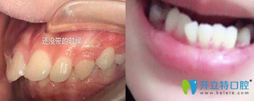 在沈陽歡樂口腔做牙齒正畸前的樣子 在沈陽歡樂口腔做牙齒正畸前的樣子