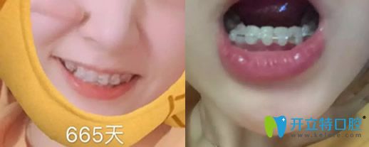 去沈陽歡樂口腔做牙齒半隱形矯正665天變化圖 去沈陽歡樂口腔做牙齒半隱形矯正665天變化圖
