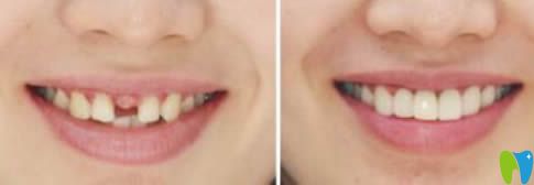 北京齒泰華口腔劉洪飛醫(yī)師單顆牙種植效果圖 北京齒泰華口腔劉洪飛醫(yī)師單顆牙種植效果圖