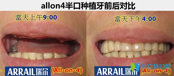 杭州瑞爾口腔allon4種植牙真實案例 杭州瑞爾口腔allon4種植牙真實案例