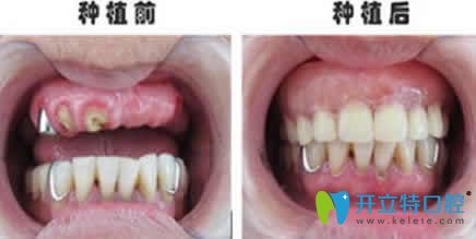 寧波尚善口腔賀剛種植牙案例效果圖 寧波尚善口腔賀剛種植牙案例效果圖