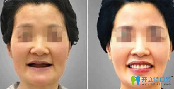 寧波尚善口腔種植牙案例效果圖 寧波尚善口腔種植牙案例效果圖