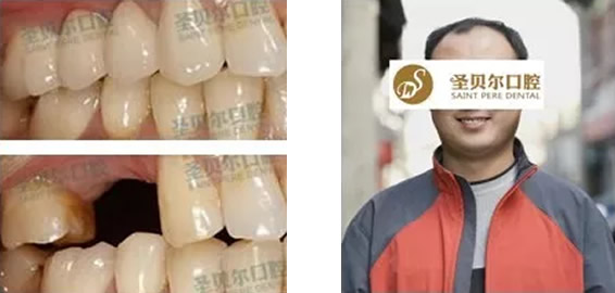 種植牙疼不疼要多久 大連圣貝爾口腔做過種植牙的人談體會