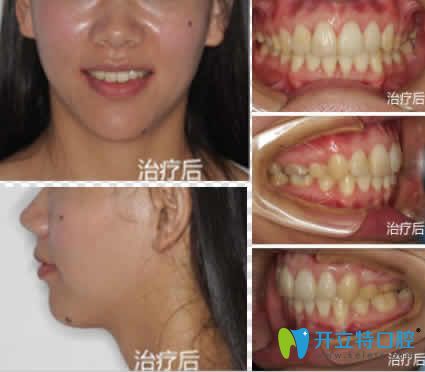 我找寧波尚善口腔李俏做隱形牙齒矯正1年效果 我找寧波尚善口腔李俏做隱形牙齒矯正1年效果