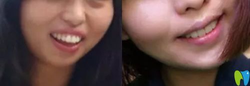 重慶牙科哪家好，看美維口腔齙牙矯正案例效果圖