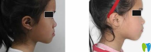 廣州瑞泰口腔<!--<i data=20240703-sp></i>-->醫(yī)生兒童地包天牙齒矯正案例及前后對比照 廣州瑞泰口腔<!--<i data=20240703-sp></i>-->醫(yī)生兒童地包天牙齒矯正案例及前后對比照