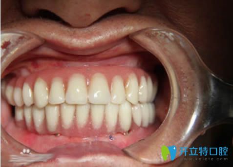 全口種植牙后即刻效果 全口種植牙后即刻效果