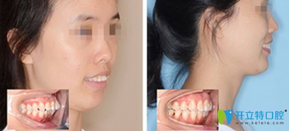 成都新橋口腔齙牙矯正效果案例