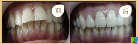 佳美口腔齙牙矯正及美白效果案例