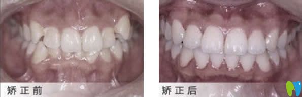 大連佳美口腔矯正牙齒9個月前后效果對比