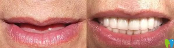 聞?dòng)钤洪L(zhǎng)全口牙缺失即刻種植牙種植案例 聞?dòng)钤洪L(zhǎng)全口牙缺失即刻種植牙種植案例