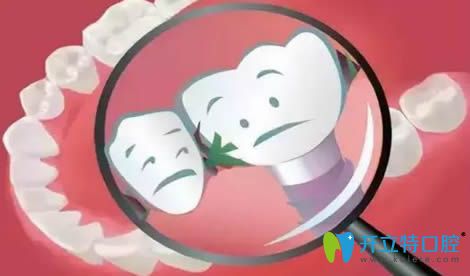 開(kāi)立特口腔網(wǎng)種植牙動(dòng)畫(huà)圖