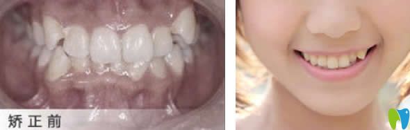 大連佳美口腔正畸前